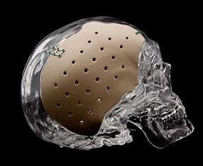 peek medical implants 480x480